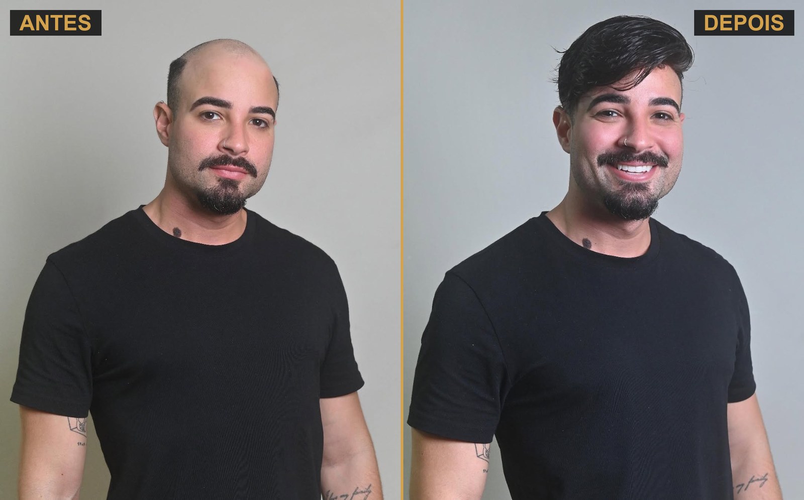 Antes e depois · prótese capilar masculina